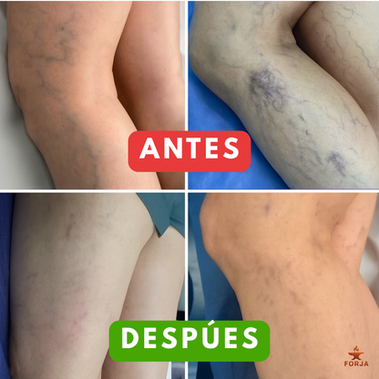 SPRAY ANTI-VÁRICES 2x1 - Piernas Firmes y Circulación Saludable